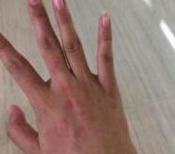 看荨麻疹过敏源的多样性
