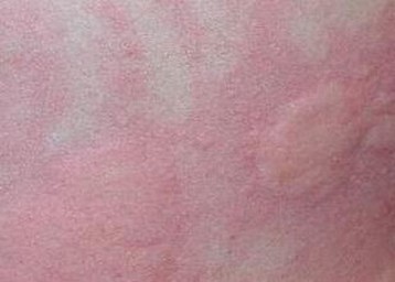 夏季易致使荨麻疹发病的原因