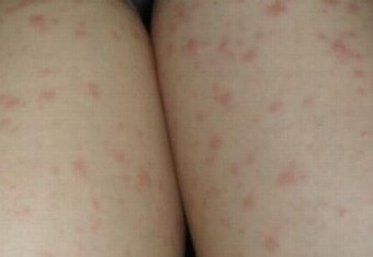 各类荨麻疹常常看见的过敏原