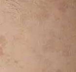 护理花斑癣的措施