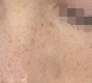 分析如何消除黄褐斑