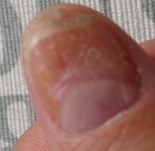 衡阳专家关于灰指甲的根本常识讲解