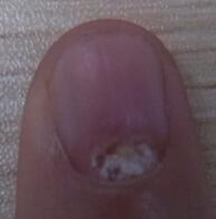 灰指甲包括哪些异常症状