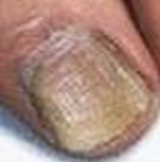 灰指甲常常看见的危害都包含什么呢 