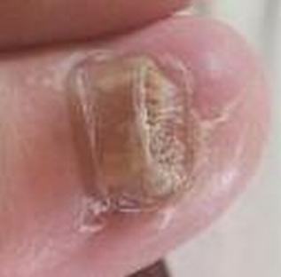 灰指甲初期病情