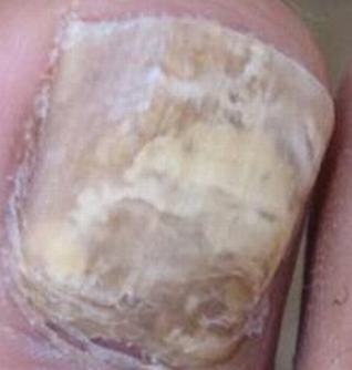 灰指甲初期病情的辨别措施