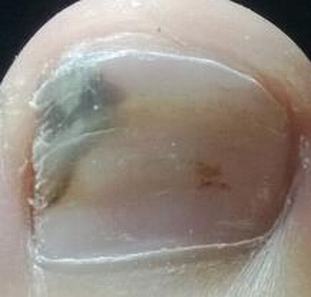 常常看见的先天性灰指甲症状