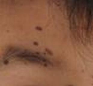 孩子身上有无色素痣怎么办