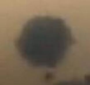 激光除掉黑色素痣