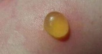 疥疮最初症状