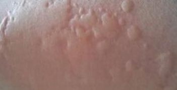 疥疮治疗时期请求留心哪些 