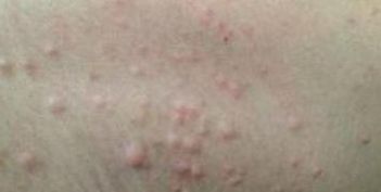女性疥疮的症状
