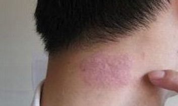 牛皮癣的伤害有什么