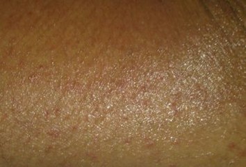 引发皮肤异痒的病因有什么