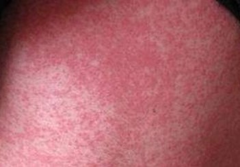 形成皮肤异痒显示的病因有什么