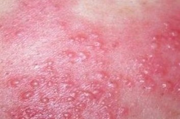 脂溢性皮炎能不能皮肤异痒