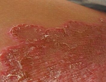 生活中股癣患者该怎样饮食