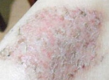 体癣的根本常识引荐