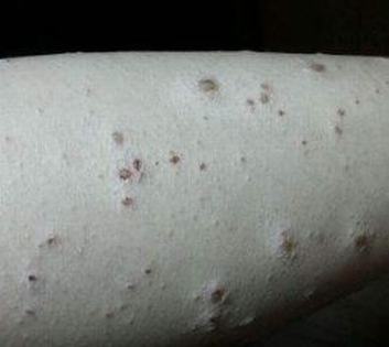 疥疮能根治吗