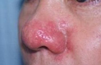 酒糟鼻的早期的症状有哪些