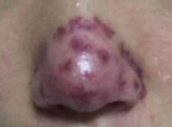 酒糟鼻的食疗方法都有啥呢