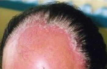 秋季怎样预防玫瑰糠疹的高发
