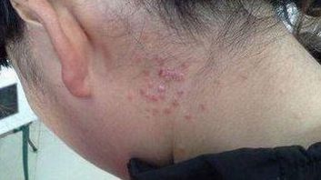 银屑病的体现是啥样子呢