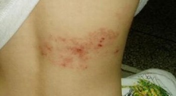 疱疹患者必要做什么检查