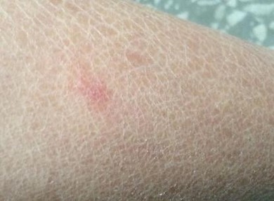 头上的鱼鳞病的注意什么事情