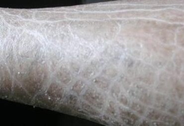 饮食不恰当是难以治愈好鱼鳞病的