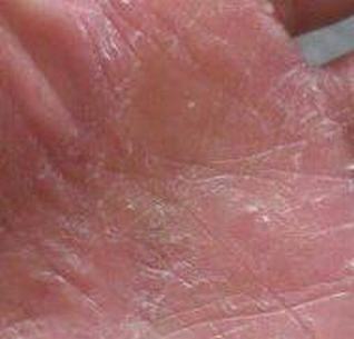手癣足癣手足癣癣是最常见的皮肤疾病青岛百姓皮肤病医院