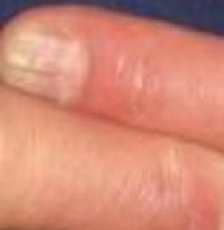 手掌上起水泡痒是否手癣