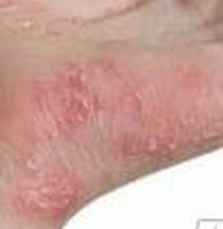 手足癣不正是后果很严重专家带你明了手足癣引发的疾病