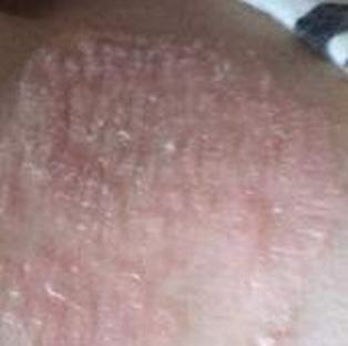 体癣的治疗偏方 