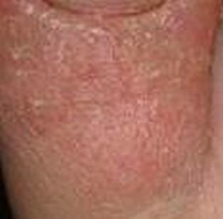 体癣给患者带来的损害