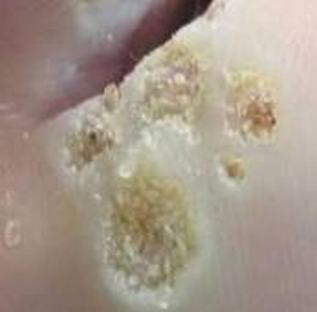 体癣要如何避免才好