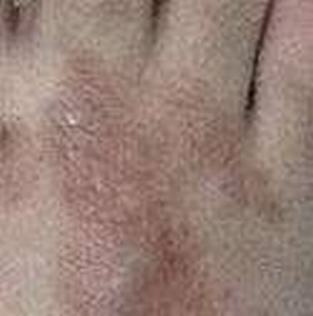 体癣的临床体现有些啥 