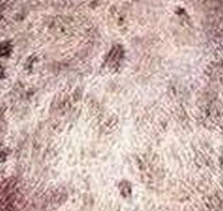 黑头癣发病的详细特征都包含什么呢