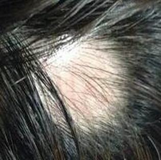 产后显示脱发该怎么办