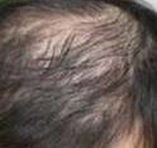常常看见的男性脱发的症状