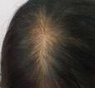 常常看见的脂溢性脱发的医治的方法