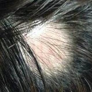 传统治疗病理性脱发的弊端