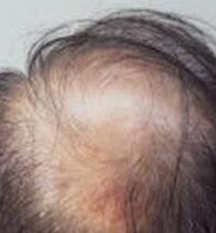 30岁左右的女性脱发患者的原因来自于哪里  