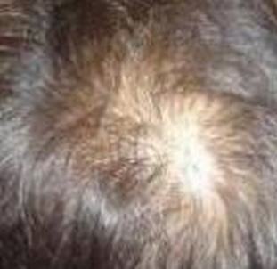 斑秃是源于什么因素致使的