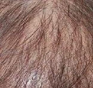 斑秃性脱发的引发原因