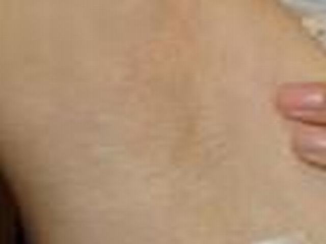 光子脱毛的诊疗原理