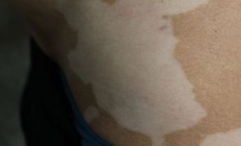 白癜风不错牵连到头发