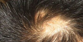 斑秃的发病有什么特点