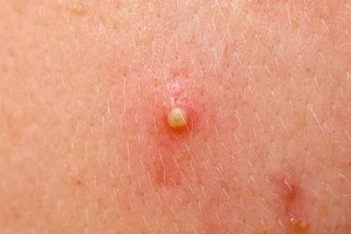 痤疮的食疗措施 (2)