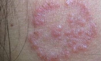患者生活防护股癣六大法